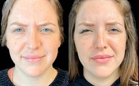 The Benefits of Botox Beyond Wrinkle Reduction at the Best Aesthetic Clinic in Dubai