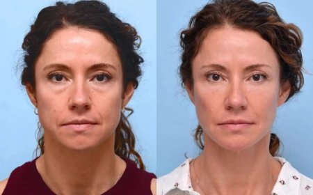 How Thread Lifts Are Tailored to Your Unique Facial Structure at the Best Aesthetic Clinic in Dubai