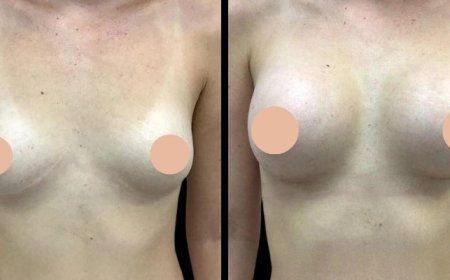 Post-Op Care Tips for a Smooth Recovery After Breast Augmentation in Dubai