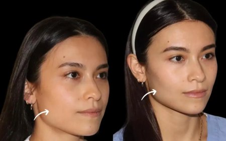 What Are Sculptra Fillers in Dubai and How Do They Work?