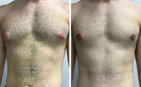 Gynecomastia Surgery in Dubai for Bodybuilders: What You Should Know
