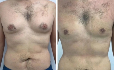 Why Choosing the Best Gynecomastia Surgeon in Dubai Can Help You Achieve a More Masculine Chest