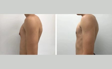 Why Men Choose the Best Gynecomastia Surgeons in Dubai for Their Transformation