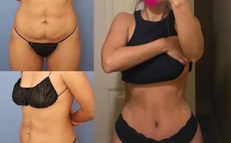 The Benefits of Tummy Tuck in Dubai for Post-Weight Loss Patients