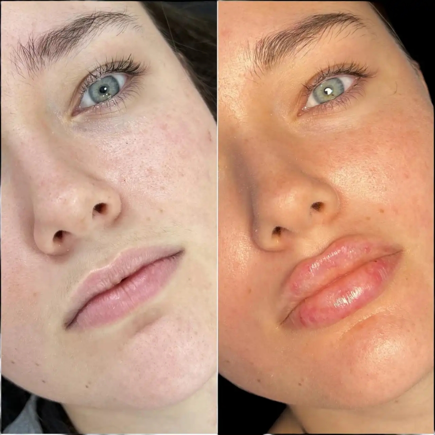 The Journey to Radiance Starts at the Best Aesthetic Clinic in Dubai for Fillers