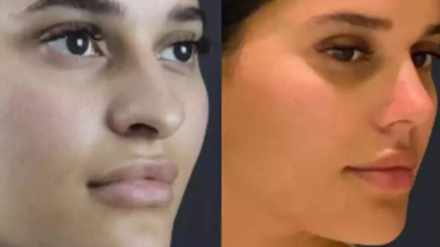 The Best Doctors in Dubai for Permanent Rhinoplasty Results