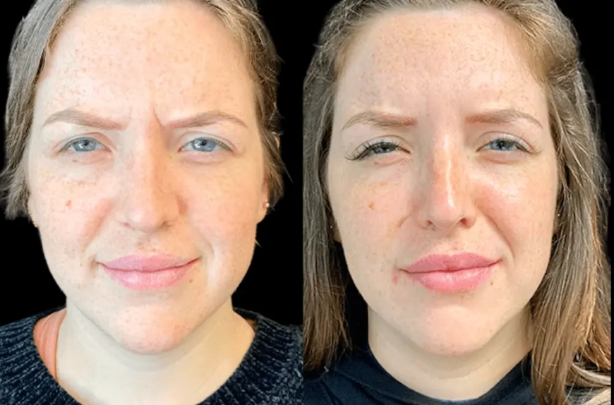 The Benefits of Botox Beyond Wrinkle Reduction at the Best Aesthetic Clinic in Dubai