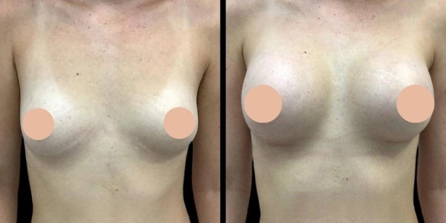 Post-Op Care Tips for a Smooth Recovery After Breast Augmentation in Dubai