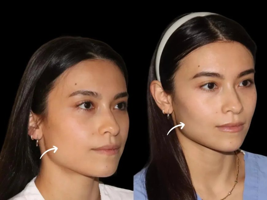 What Are Sculptra Fillers in Dubai and How Do They Work?