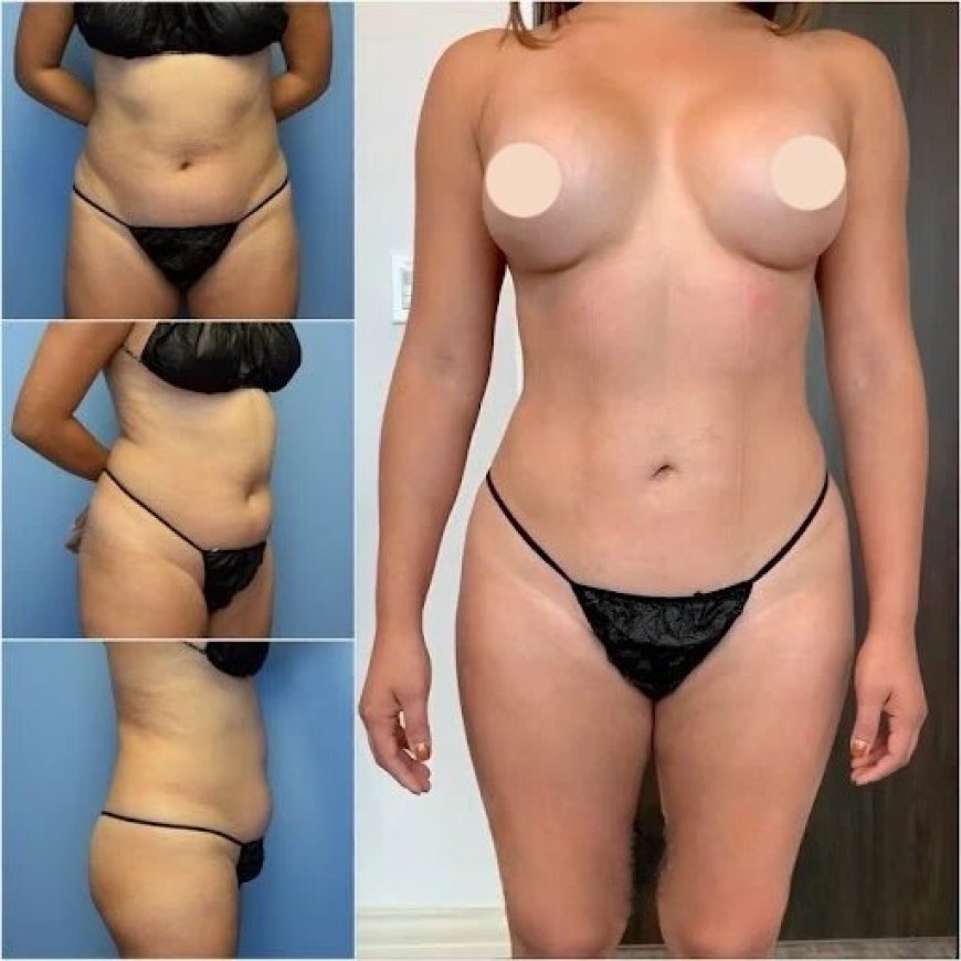How Body Contouring in Dubai Creates Beautiful, Defined Curves