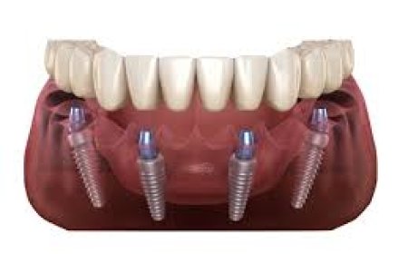 Tout savoir sur le traitement implants dentaires : une solution durable pour votre sourire