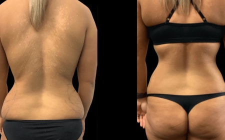 The Benefits of Personalized Care from the Best Butt Fat Transfer Surgeons in Dubai