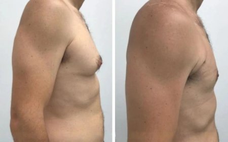 Why the Best Doctors in Dubai Are Experts in Male Gynecomastia Surgery