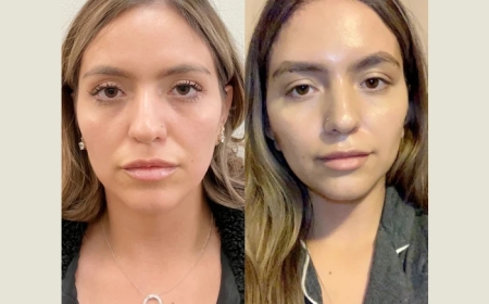 The Cost of Thread Lift at the Best Aesthetic Clinic in Dubai: Is It Worth It?