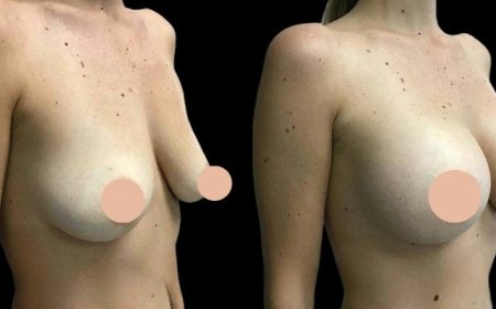 How the Best Doctors in Dubai Help You Choose the Right Size and Shape for Your Breast Augmentation