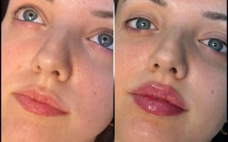 Why the Best Aesthetic Clinics in Dubai Are Leading in Fillers Treatments