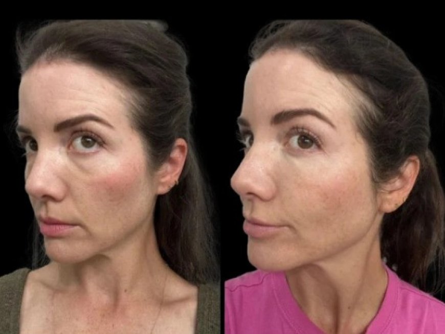 Why the Best Plastic Surgeons in Dubai Recommend Customized Dark Circles Treatments