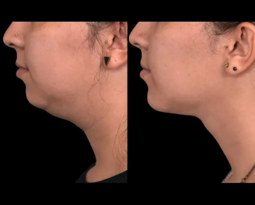 What You Need to Know About Double Chin Removal Surgery in Dubai